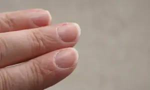 Pękająca skóra przy paznokciach, sucha i szorstka, wymaga nawilżenia.